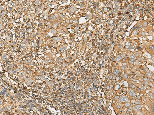 Immunohistochemistry of paraffin-embedded Human cervical cancer tissue using UBE2A Polyclonal Antibody at dilution of 1:55(×200)