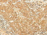 Immunohistochemistry of paraffin-embedded Human lung cancer tissue using KRT76 Polyclonal Antibody at dilution of 1:30(×200)