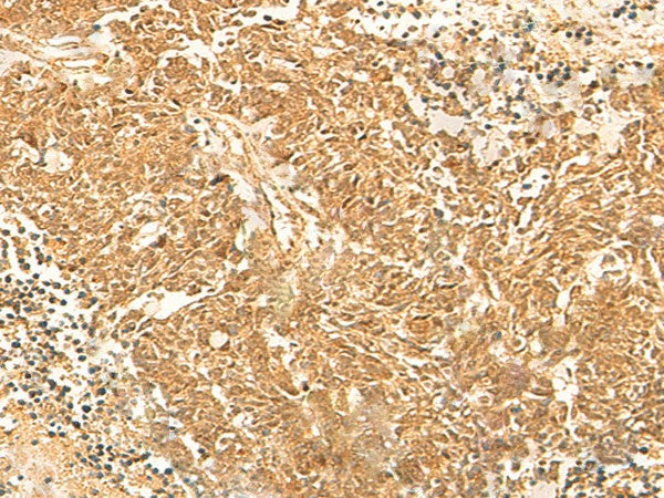 Immunohistochemistry of paraffin-embedded Human lung cancer tissue using KRT76 Polyclonal Antibody at dilution of 1:30(×200)