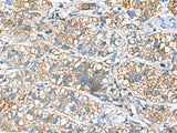 Immunohistochemistry of paraffin-embedded Human liver cancer tissue using JOSD1 Polyclonal Antibody at dilution of 1:90(×200)