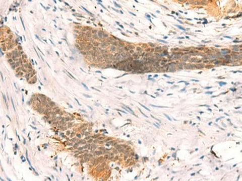 Immunohistochemistry of paraffin-embedded Human esophagus cancer tissue using SETD1A Polyclonal Antibody at dilution of 1:40(×200)