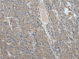 Immunohistochemistry of paraffin-embedded Human liver cancer tissue using USP32 Polyclonal Antibody at dilution of 1:75(×200)