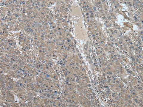 Immunohistochemistry of paraffin-embedded Human liver cancer tissue using USP32 Polyclonal Antibody at dilution of 1:75(×200)