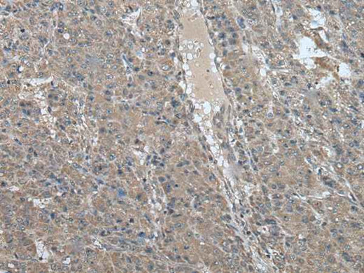 Immunohistochemistry of paraffin-embedded Human liver cancer tissue using USP32 Polyclonal Antibody at dilution of 1:75(×200)