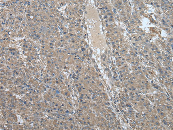 Immunohistochemistry of paraffin-embedded Human liver cancer tissue using USP32 Polyclonal Antibody at dilution of 1:75(×200)