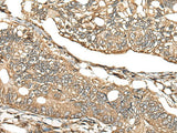 Immunohistochemistry of paraffin-embedded Human gastric cancer tissue using CA11 Polyclonal Antibody at dilution of 1:30(×200)