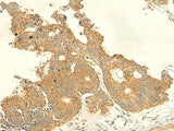 Immunohistochemistry of paraffin-embedded Human colorectal cancer tissue using IFT27 Polyclonal Antibody at dilution of 1:50(×200)