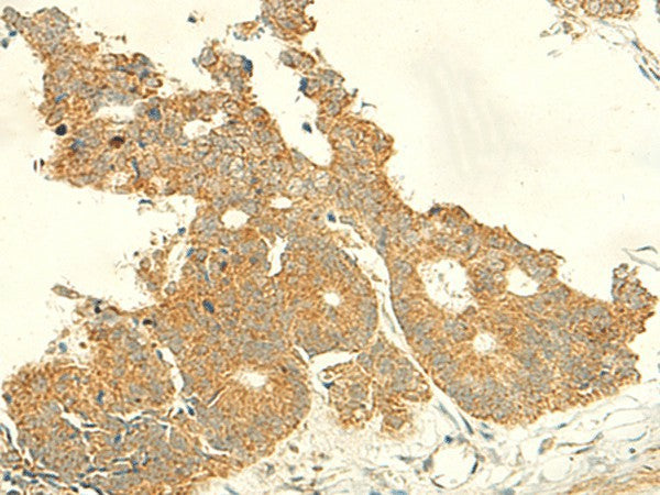 Immunohistochemistry of paraffin-embedded Human colorectal cancer tissue using IFT27 Polyclonal Antibody at dilution of 1:50(×200)