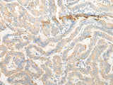 Immunohistochemistry of paraffin-embedded Human thyroid cancer tissue using CELA3A Polyclonal Antibody at dilution of 1:25(×200)