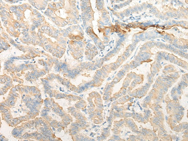 Immunohistochemistry of paraffin-embedded Human thyroid cancer tissue using CELA3A Polyclonal Antibody at dilution of 1:25(×200)