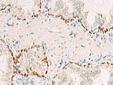 Immunohistochemistry of paraffin-embedded Human prost at e cancer tissue using TP63 Polyclonal Antibody at dilution of 1:40(×200)