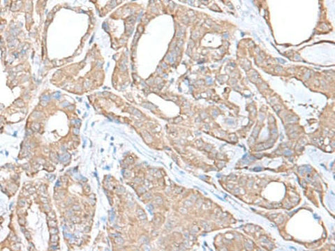 Immunohistochemistry of paraffin-embedded Human thyroid cancer tissue using C9orf116 Polyclonal Antibody at dilution of 1:55(×200)
