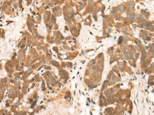 Immunohistochemistry of paraffin-embedded Human thyroid cancer tissue using NRG2 Polyclonal Antibody at dilution of 1:65(×200)