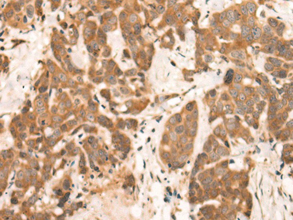Immunohistochemistry of paraffin-embedded Human thyroid cancer tissue using NRG2 Polyclonal Antibody at dilution of 1:65(×200)