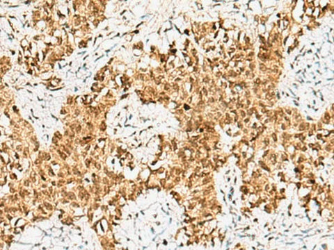Immunohistochemistry of paraffin-embedded Human ovarian cancer tissue using CRCP Polyclonal Antibody at dilution of 1:65(×200)