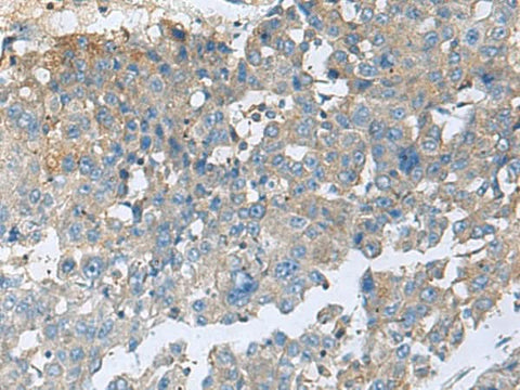 Immunohistochemistry of paraffin-embedded Human liver cancer tissue using CEMIP Polyclonal Antibody at dilution of 1:60(×200)