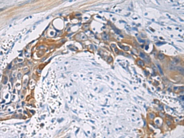 Immunohistochemistry of paraffin-embedded Human esophagus cancer tissue using CEP89 Polyclonal Antibody at dilution of 1:100(×200)