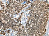 Immunohistochemistry of paraffin-embedded Human thyroid cancer tissue using CBFA2T3 Polyclonal Antibody at dilution of 1:45(×200)