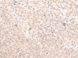 Immunohistochemistry of paraffin-embedded Human ovarian cancer tissue using HOOK2 Polyclonal Antibody at dilution of 1:30(×200)