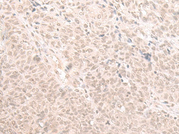 Immunohistochemistry of paraffin-embedded Human ovarian cancer tissue using HOOK2 Polyclonal Antibody at dilution of 1:30(×200)