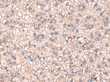 Immunohistochemistry of paraffin-embedded Human liver cancer tissue using SARS Polyclonal Antibody at dilution of 1:60(×200)