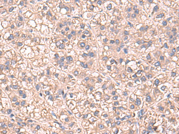 Immunohistochemistry of paraffin-embedded Human liver cancer tissue using SARS Polyclonal Antibody at dilution of 1:60(×200)