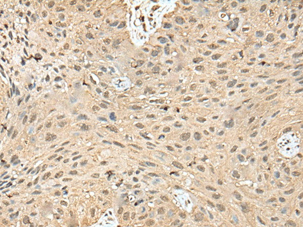 Immunohistochemistry of paraffin-embedded Human lung cancer tissue using ATXN3 Polyclonal Antibody at dilution of 1:50(×200)