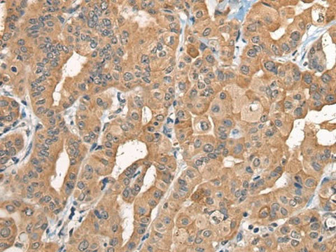 Immunohistochemistry of paraffin-embedded Human thyroid cancer tissue using BCAN Polyclonal Antibody at dilution of 1:35(×200)
