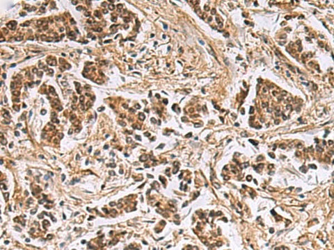 Immunohistochemistry of paraffin-embedded Human breast cancer tissue using DNA2 Polyclonal Antibody at dilution of 1:40(×200)