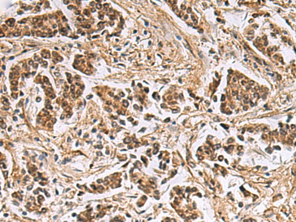 Immunohistochemistry of paraffin-embedded Human breast cancer tissue using DNA2 Polyclonal Antibody at dilution of 1:40(×200)