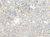 Immunohistochemistry of paraffin-embedded Human liver cancer tissue using ZNF449 Polyclonal Antibody at dilution of 1:50(×200)