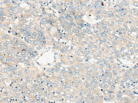 Immunohistochemistry of paraffin-embedded Human liver cancer tissue using ZNF449 Polyclonal Antibody at dilution of 1:50(×200)