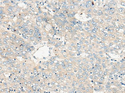 Immunohistochemistry of paraffin-embedded Human liver cancer tissue using ZNF449 Polyclonal Antibody at dilution of 1:50(×200)