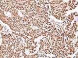 Immunohistochemistry of paraffin-embedded Human lung cancer tissue using RCOR3 Polyclonal Antibody at dilution of 1:55(×200)