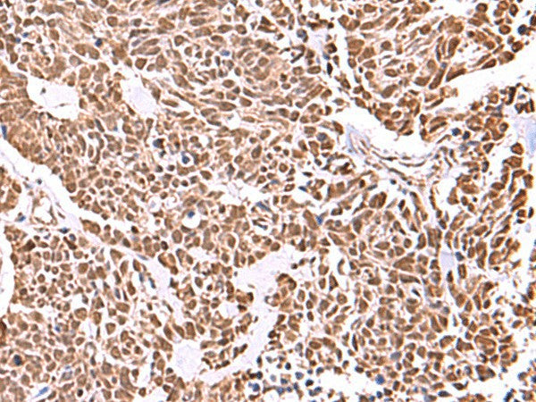 Immunohistochemistry of paraffin-embedded Human lung cancer tissue using RCOR3 Polyclonal Antibody at dilution of 1:55(×200)