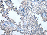 Immunohistochemistry of paraffin-embedded Human ovarian cancer tissue using ATM Polyclonal Antibody at dilution of 1:65(×200)