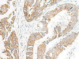 Immunohistochemistry of paraffin-embedded Human colorectal cancer tissue using FGR Polyclonal Antibody at dilution of 1:70(×200)