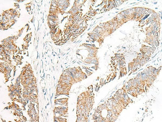 Immunohistochemistry of paraffin-embedded Human colorectal cancer tissue using FGR Polyclonal Antibody at dilution of 1:70(×200)