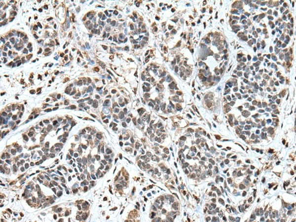Immunohistochemistry of paraffin-embedded Human esophagus cancer tissue using UPK3A Polyclonal Antibody at dilution of 1:55(×200)