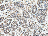 Immunohistochemistry of paraffin-embedded Human esophagus cancer tissue using UPK3A Polyclonal Antibody at dilution of 1:55(×200)