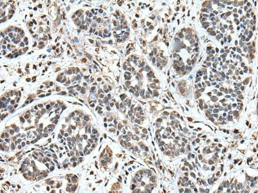 Immunohistochemistry of paraffin-embedded Human esophagus cancer tissue using UPK3A Polyclonal Antibody at dilution of 1:55(×200)
