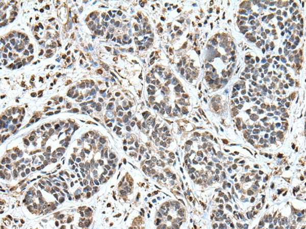 Immunohistochemistry of paraffin-embedded Human esophagus cancer tissue using UPK3A Polyclonal Antibody at dilution of 1:55(×200)