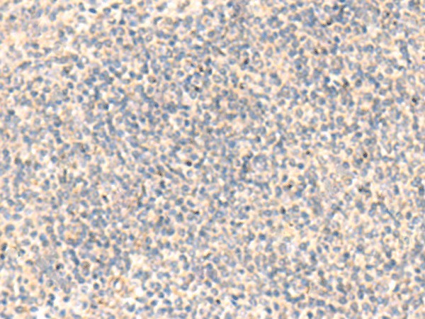 Immunohistochemistry of paraffin-embedded Human tonsil tissue using ADAMTS2 Polyclonal Antibody at dilution of 1:45(×200)