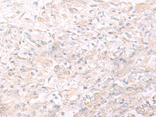 Immunohistochemistry of paraffin-embedded Human liver cancer tissue using IL26 Polyclonal Antibody at dilution of 1:65(×200)
