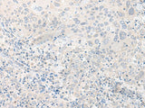 Immunohistochemistry of paraffin-embedded Human cervical cancer tissue using TIMM8A Polyclonal Antibody at dilution of 1:50(×200)