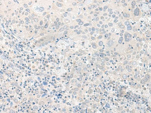Immunohistochemistry of paraffin-embedded Human cervical cancer tissue using TIMM8A Polyclonal Antibody at dilution of 1:50(×200)