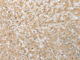 Immunohistochemistry of paraffin-embedded Human liver cancer tissue using FNDC3B Polyclonal Antibody at dilution of 1:45(×200)