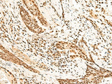 Immunohistochemistry of paraffin-embedded Human esophagus cancer tissue using HOXC13 Polyclonal Antibody at dilution of 1:60(×200)