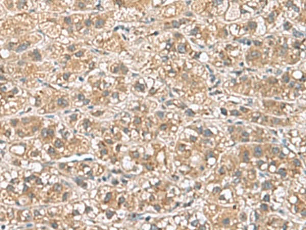 Immunohistochemistry of paraffin-embedded Human liver cancer tissue using PHLDA3 Polyclonal Antibody at dilution of 1:110(×200)