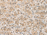 Immunohistochemistry of paraffin-embedded Human liver cancer tissue using PHLDA3 Polyclonal Antibody at dilution of 1:110(×200)